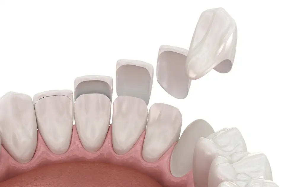 Eine 3D-Simulation, die zeigt wie Veneers funktionieren: Auf eine untere Zahnreihe werden je Zahn Kunststoffschalen wie eine Hülle aufgesetzt. Die Form richtet sich dabei nach dem jeweiligen Zahn.